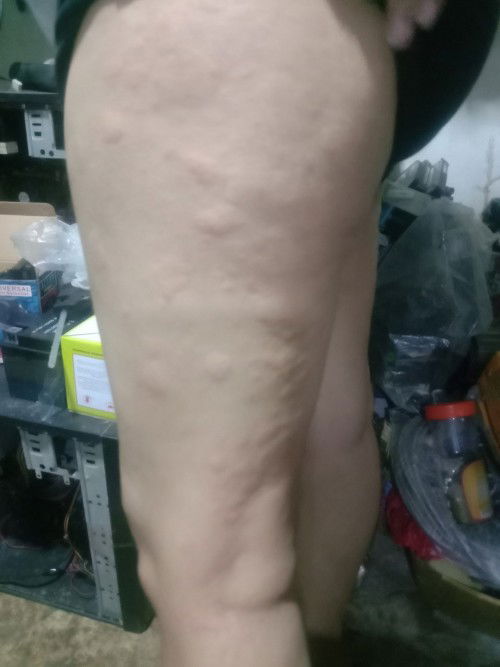 Hi po mga mii sino same case dto na nagpapantal hbang ngbubuntis? Anu gnawa nyo 33 weeks and 5days