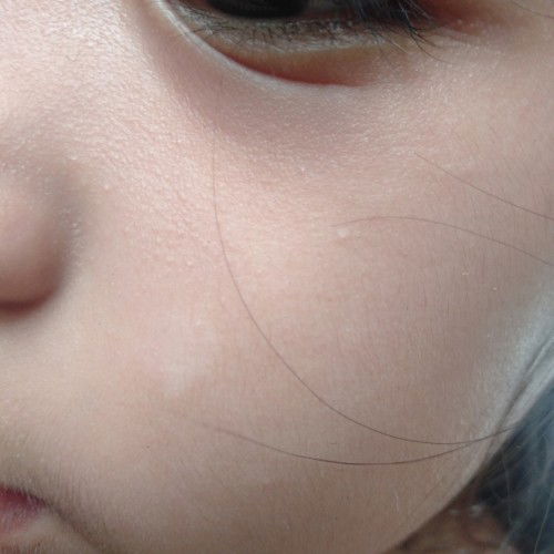 white spot in skin