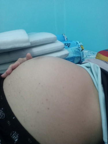 ผดผื่นเต็มท้องเลยคุณลูกชาย