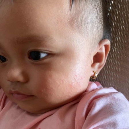 Bé nhà e 10 tháng bị nổi những hạt li ti đầy hai bên má luôn. Các mom giúp e với ạ. E cảm ơn !