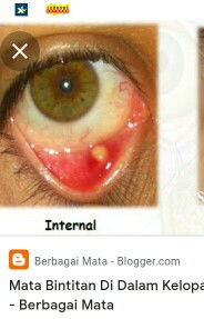 Bintitan mata😫