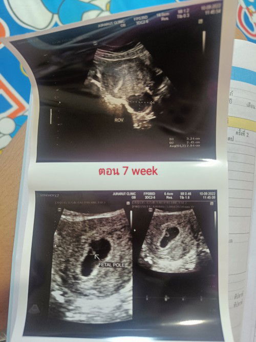 การตั้งครรภ์