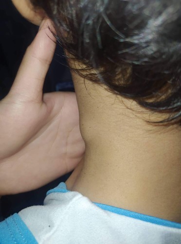 Ano po kaya yan tumubo sa anak ko na bukol may ubo po sya na matigas paki sagot naman parents thanks