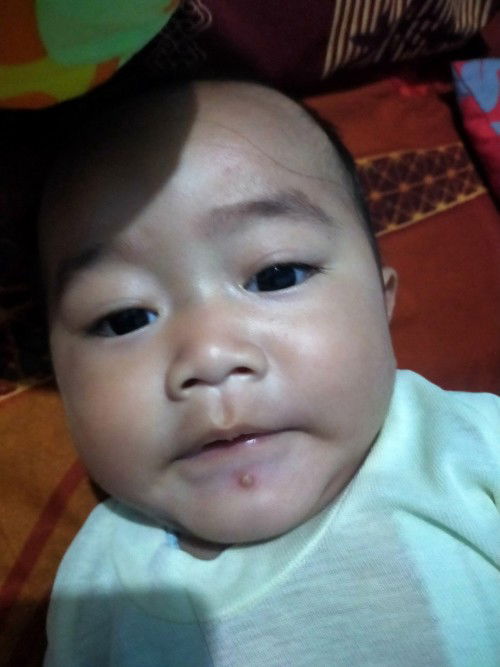 Bentol bentol berair