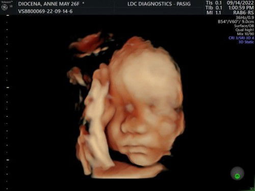 3D/4D Ultrasound