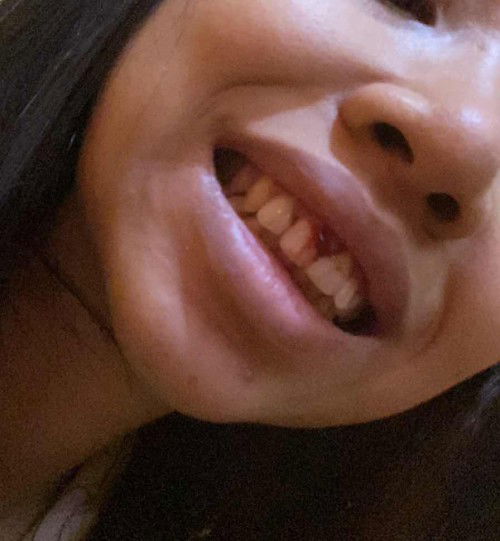 Gusi berdarah saat hamil