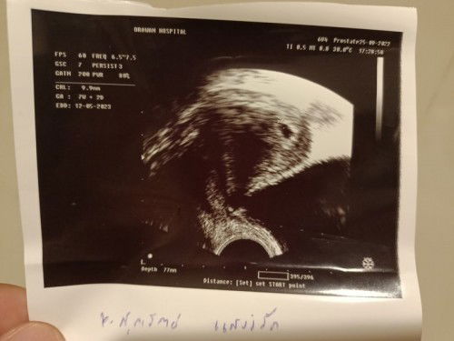 กังวลทารกในท้อง