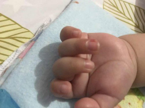 merah bengkak diujung jari