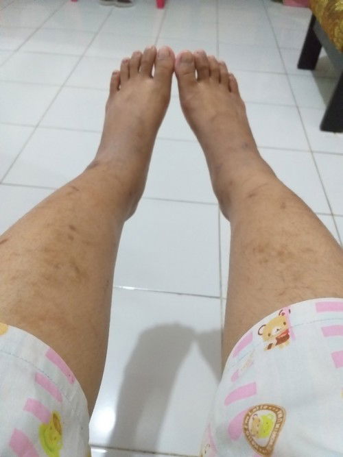 Kenapa Pas melahirkan udh dapat 2 hari kaki Bengkak padahal udh melahirkan