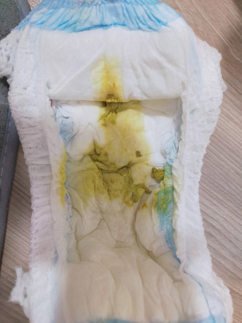 น้องสองเดือน อุจจาระสีแบบนี้ ถือว่าสีซีดรึป่าวครับ