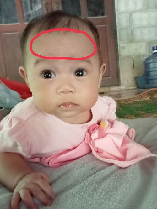 กลากเกลื้อน