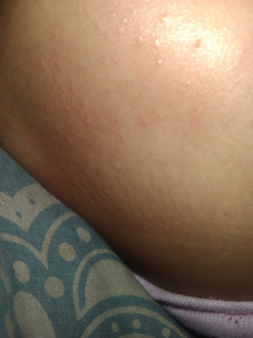 Bruntusan di Deket belahan atas pantat bayi