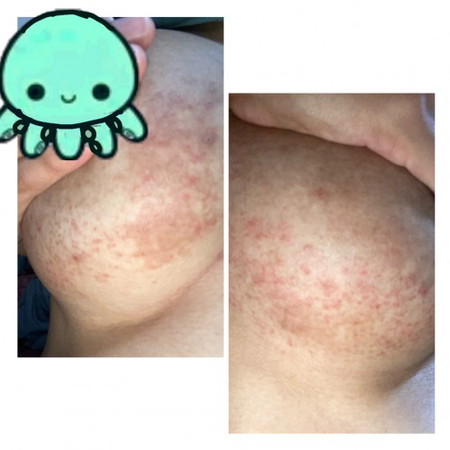 ผื่นคันแดง บริเวรเต้านม