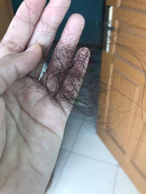 Rambut rontok