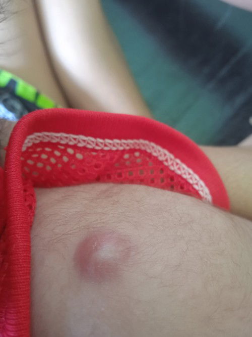 ถามเรื่องตุ่มลูก