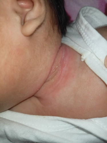 Sugat at nana sa leeg