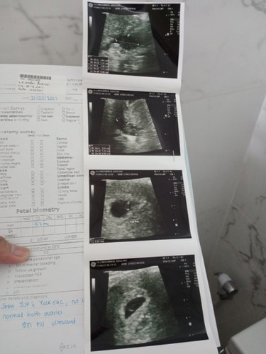 ยังไม่เจอตัวอ่อน