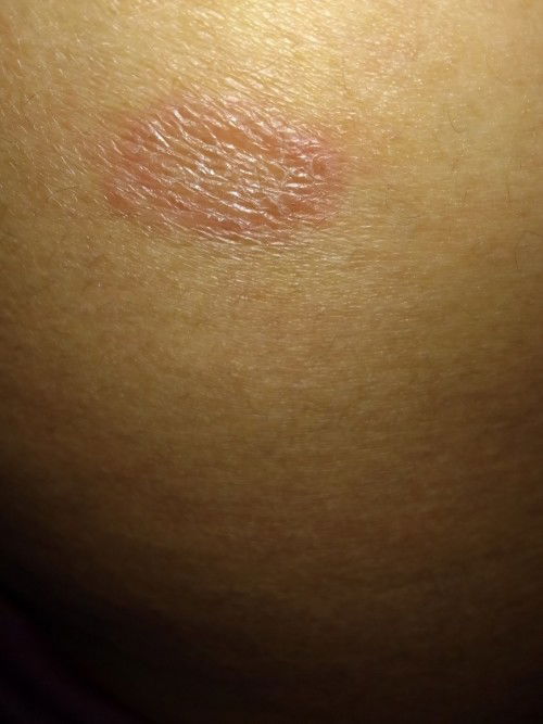 Gatal² diusia kandungan 21w