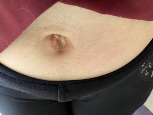 สอบถามคุณแม่ๆหน่อยค่ะ ในรูสะดือมีตุ่มน้ำใสๆ