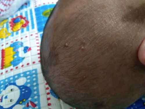 Ada bintik seperti jerawat dikepala bayi