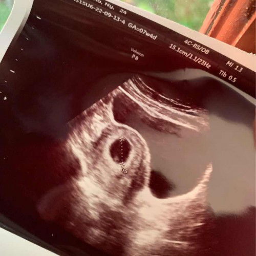 Usia Kandungan 7weeks masih kantung saja?