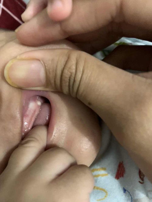 Bintik putih di gusi bayi