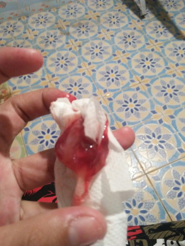 39wโดนกระตุ้น/กวาดปากมดลูก
