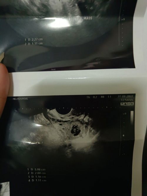 หมอบอกโอกาศท้องนอกมดลูกสูง