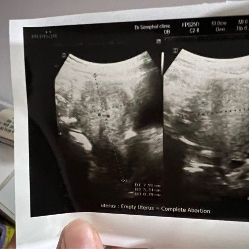 แท้งไม่รู้ตัว มีใครเคยเป็นบ้างค่ะ