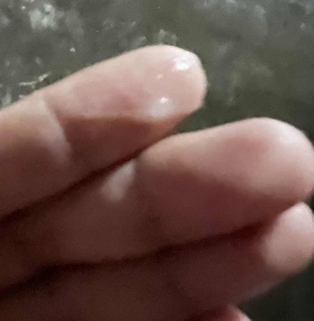 สอบถามแม่ๆค่ะมีอาการท้องปั้นเเข็ง แต่ไม่มีอาการปวด มีมูกใสๆไหลออกมาแบบนี้ต้องไปหาหมอเลยมั้ยค่ะ
38w1d
