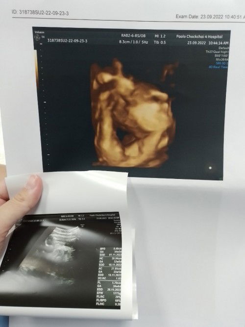 คลอดตอน 34weeks