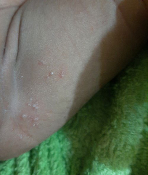 Bintik berair di paha