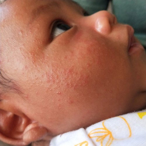 Bruntusan merah merah