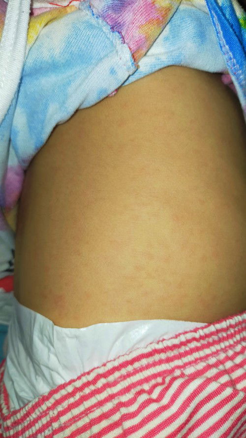 Tigdas hangin sa baby