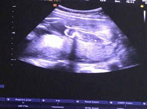 อัลตร้าซาว23สัปดาห์