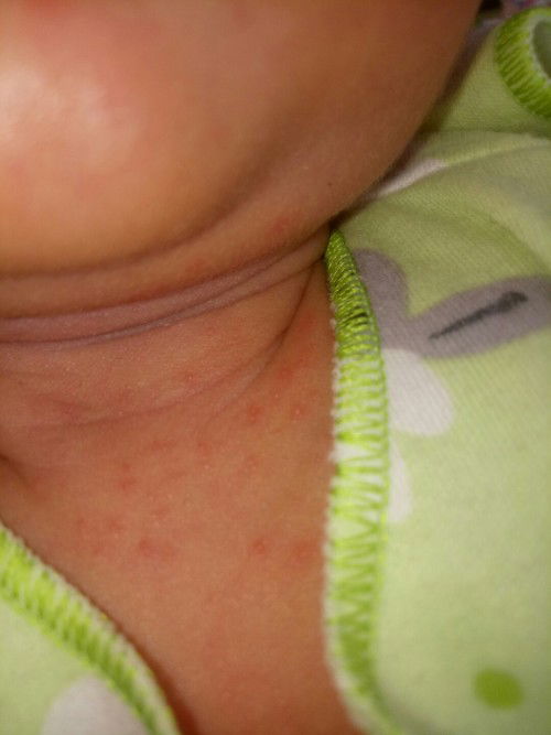 Bunda tau ngak obat buat bintik merah