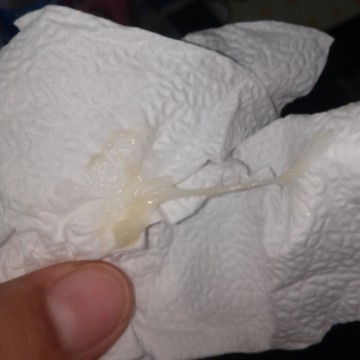 แม่ๆคะมันคือตกขาวหรือมูกคะ39wวันนึ้ค่ะ