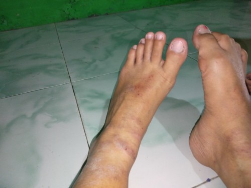 Kaki gatal2