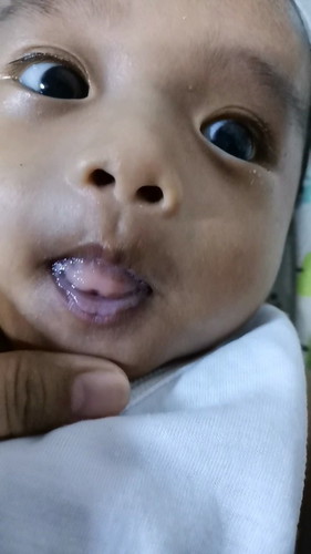Hello po. Ask ko lang po sa merong naka exp. Na may tounge tie ang baby. 3mos and 2 weeks po si baby