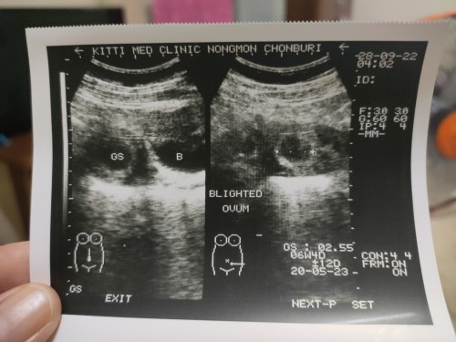 ท้อง 7 สัปดาห์ 2 วัน