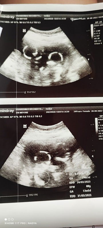 Apa anak kembar bisa beda HPL nya?