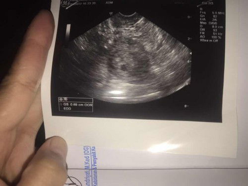 Cek usg transvaginal penampakan seperti ada 2 kantung