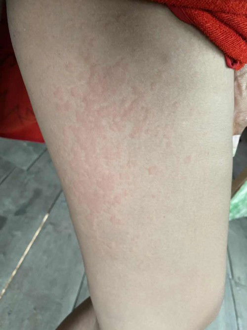 ลมพิษหรือเปล่าคะ🥹