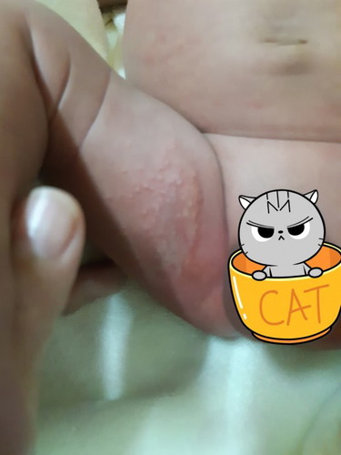 ผื่นผ้าอ้อม