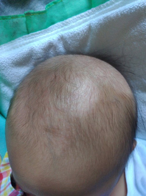 Ano po kaya tong nasa ulo ng baby ko 3 months old