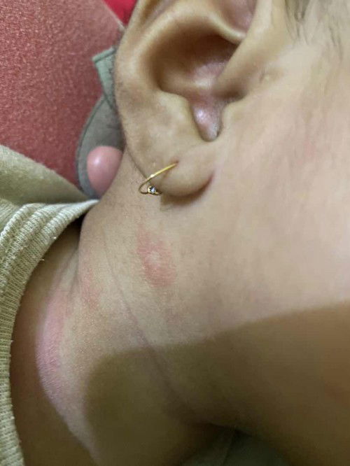 Ruam merah di sekitar leher