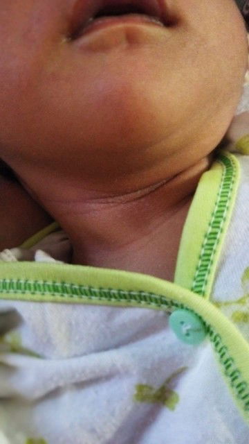 Bercak putih di leher bayi