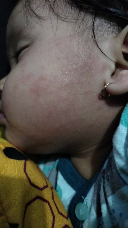 Ruam Dan bintik merah di wajah