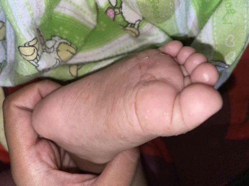 BENTOL BENTOL BERAIR DITELAPAK KAKI DAN TANGAN