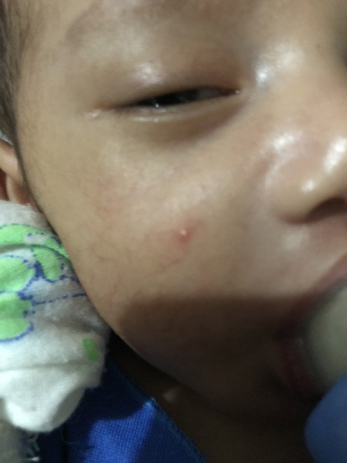 Jerawat di pipi bayi